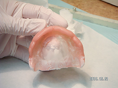 治療用義歯3